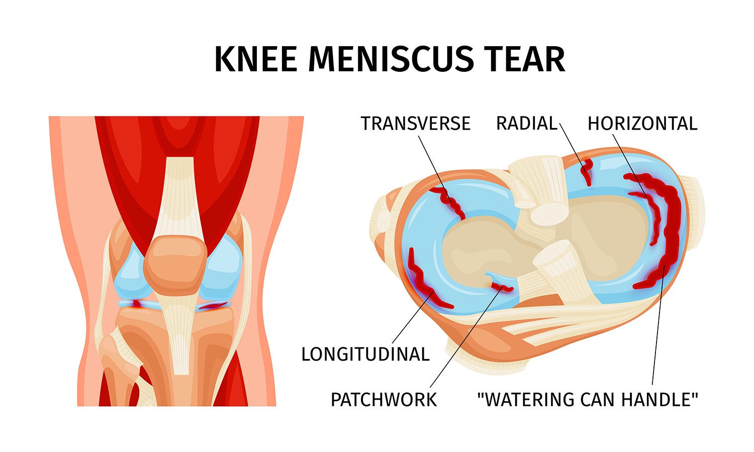 La chirurgie du cartilage La chirurgie du cartilage